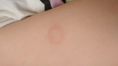 Kuntakintos - @amonwar: jesteś lekarzem? Dzisiaj u 5 letniej córki zaobserwowałem dwa...