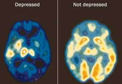 coolcooly22 - Czy kazda depresja oznacza zmiany w mózgu? Czy depresja jest dopiero sp...