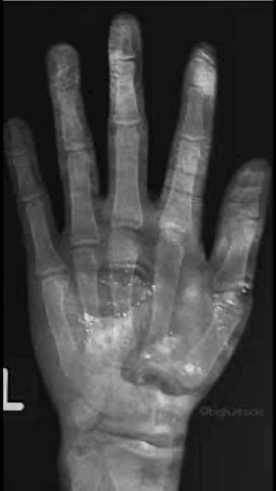 MuzG - Zdjęcie rentgenowskie złamania w prawej dłoni LeBrona Jamesa (złamania doznał ...