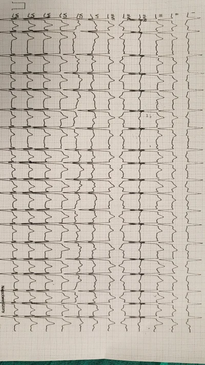 dzejdzejdzej - Jest tu jakiś szpec?
#kardiologia #ekg #medycyna #interpretacja