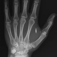 KaczuszkaBezBrzuszka - Wizyta umówiona do końca tygodnia będę miał implant nfc w dłon...