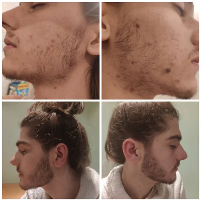 Damian77777 - Z reddita - przed i po 2 miesiącach stosowania minoxidilu na brodę. 
#...