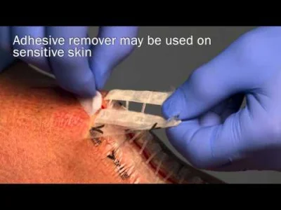 mafiozorek3 - Alternatywna dla zszywania metoda zamykania rozciętej skóry przy użyciu...