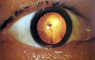myrmekochoria - Oko z atomową kataraktą (po czasie się rozwija) osoby, która przeżyła...