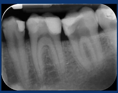 shaelix92 - Lekarz stwierdził że ząb nie do wyratowania, na zdjęciu widać rzekomą per...