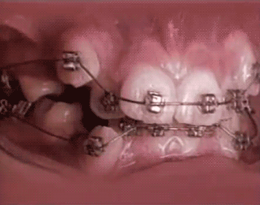 zerthimon - #gif ukazujący korekcję uzębienia przy zastosowaniu aparatu ortodontyczne...
