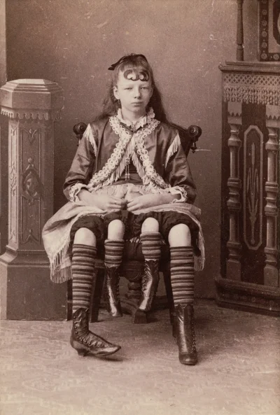 myrmekochoria - Josephine Myrtle Corbin (1868 - 1928) urodzona z dodatkowymi nogami (...