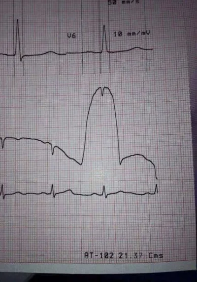 laress - Byłem w weekend w szpitalu i miałem badanie serca. EKG wykazało taki wykres....