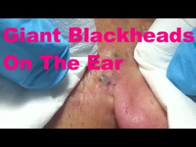 Lord_Hunter - fuuu co mnie podkusiło aby oglądać blackhead popping....

SPOILER

...