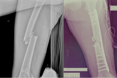 niewidzialnywszechmogacy - @zarev: @coskoduje: Moja kość udowa przed i zaraz po opera...