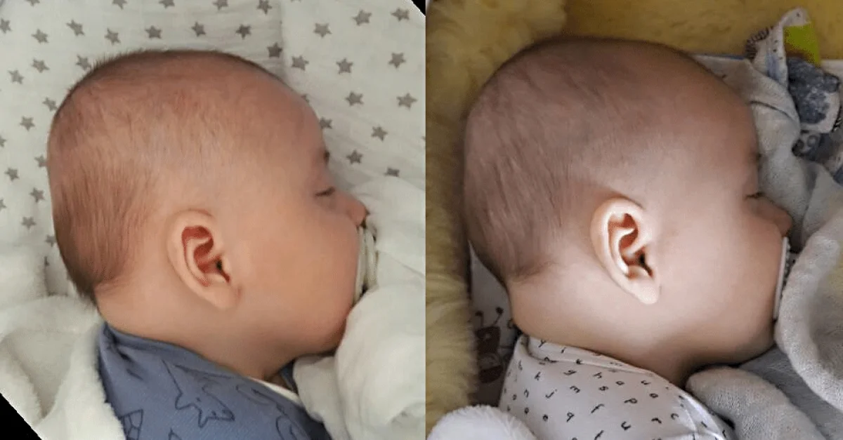Когда ребенок рождается с волосами на лице