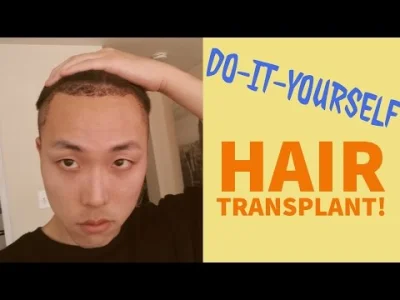 dr_Klotz - Dla beki wpisałem "DIY hair transplant" i nie uwierzycie. Ludzie naprawdę ...