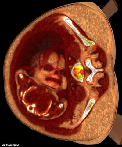 palikowaty - Kolorowa tomografia komputerowa.. Uroczy bombelek.. ( ಠ_ಠ) #medycyna #ci...