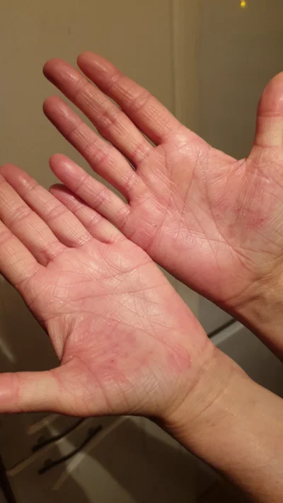 just_mike - Mirki z #medycyna mama ma problem z dłońmi od kilku dni. Pic rel poniżej
...