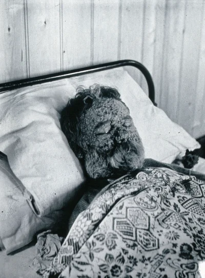 myrmekochoria - George Steel podczas epidemii ospy w Anglii, 1896 rok. 

#starszezw...