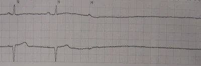 megawatt - > Tak, tylko że zapis EKG na monitorze jest aktualizowany co ileś sekund. ...