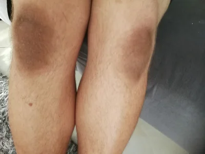 jmuhha - Takie plamy na kolanach mogą oznaczać u pacjentów problemy endokrynologiczne...