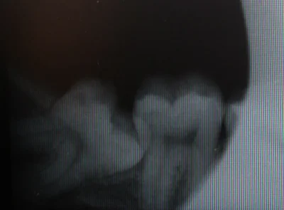 bomboor - Tak wygląda mój dolny ząb mądrości (╯︵╰,)
#stomatologia
#przegryw
#denty...