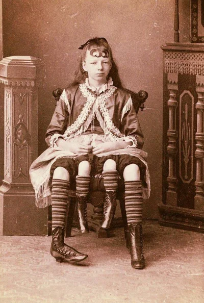 azsnz - Sfotografowana w 1880 r. Myrtle Corbin miała dwie oddzielne miednice i dwie p...
