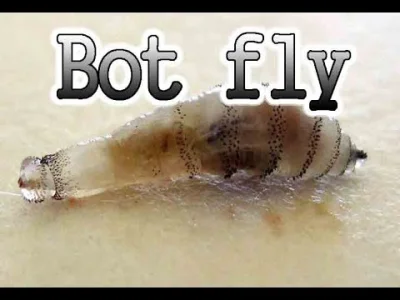 anna-karenova - #Botfly 
Bot fly popping. Biggest bot fly removal "All pimples Chann...