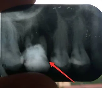 coolcooly22 - Zrobiłem RTG zęba górnego 6. Był kiedyś leczony ale co jakiś czas nad n...