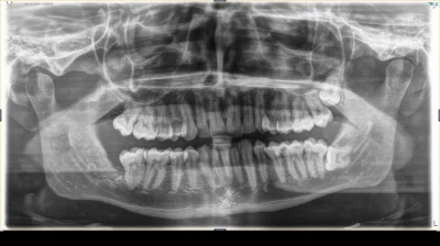 Ambiwalentnik - Zdjęcie pantomograficzne zębów, proszę o pomoc. Ból po prawej stronie...