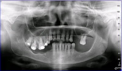 m4tthew - A tu taki skrajny przypadek efektu Godona. Zęby szukały kontaktu, aż znalaz...