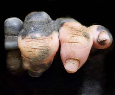 cieliczka - Dłoń goryla z ubytkami w pigmentacji

Trochę podobna . (źródło)

edit...