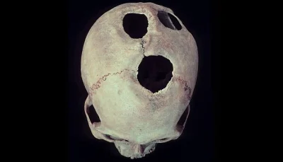Czajna_Seczen - Wykopiecie? :)

Trepanacja czaszek w prekolumbijskim Peru - Dokładn...