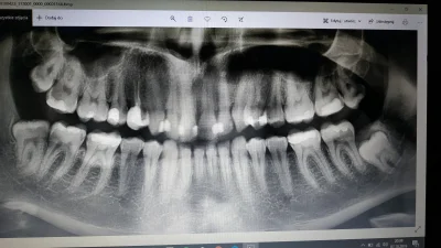 Szeretlek - Mirasy ze #stomatologia #dentysta
Boli mnie prawa dolna ósemka. Rtg z kwi...