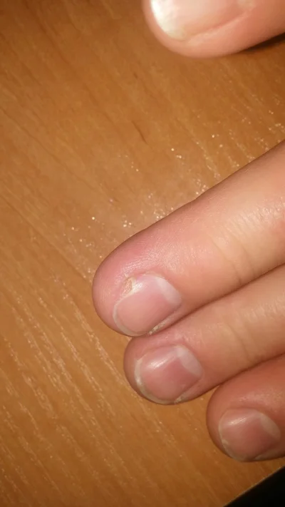 berecik - #paznokcie #dermatologia #kiciochpyta #pytanie 
Mam problem z paznokciem. B...