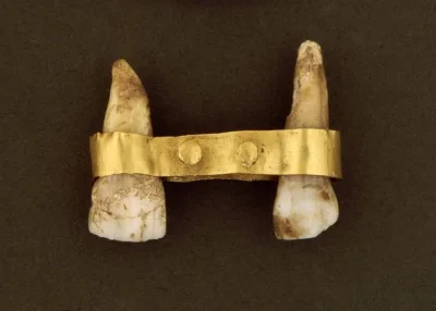 myrmekochoria - Złota opaska trzymająca zęby, Etruskowie 700 rok przed naszą erą. Bol...
