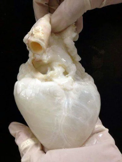 D.....d - Mięsień sercowy pozbawiony całkowicie z krwi.

#ciekawostki #anatomia