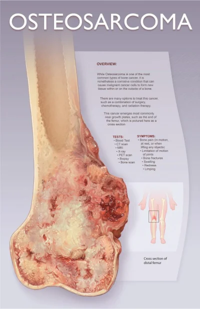 tojestmultikonto - @Koperek01: osteosarcoma wygląda zupełnie inaczej