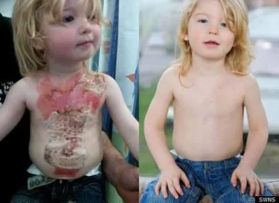 Kosciany - Two year old with second degree burns treated with stem cell therapy for a...