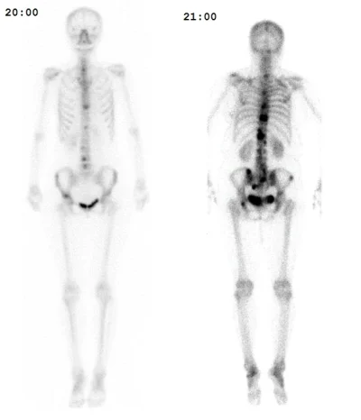 Adenocarcinoma - @Madin5: