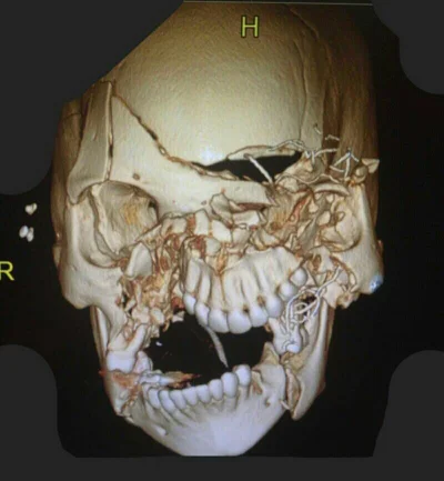 tomosano - Skan czaszki pasażera po wypadku drogowym, który nie miał zapiętych pasów
...