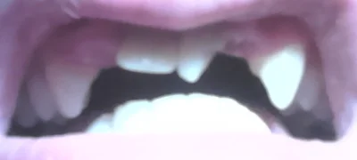 silownia - Jest tu jakiś dentysta albo ortodonta? Warto coś robić z takimi zębami czy...