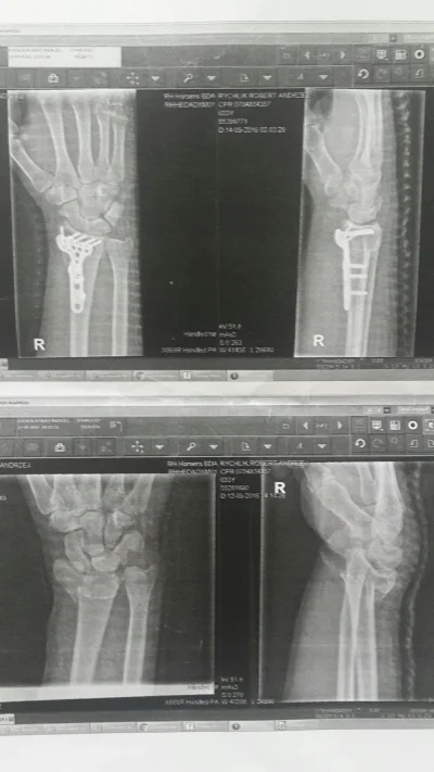 roberto07 - No i po zabawie. Lewa tez polamana ale jeszcze przed operacja