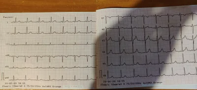 ipconfig - Mirki jest ktoś z was w stanie zinterpretować wyniki EKG?
#ekg #medycyna ...