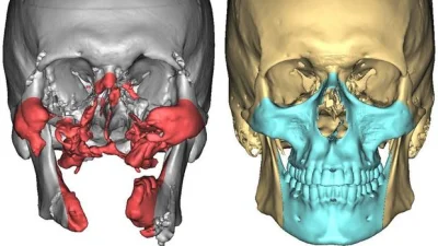 R187 - >Surgical planning images of the recipient's skull, left, and the the donor's,...