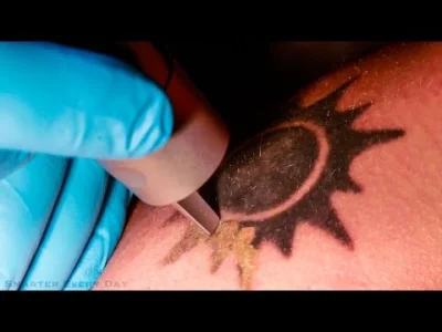 parsiuk - Jak działa laserowe usuwanie tatuaży. No i sam tatuaż... Nie wiedziałem, że...