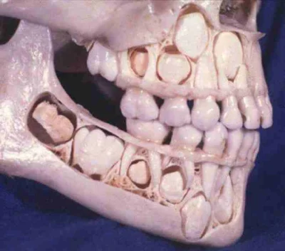 ixem - Tak wygląda czaszka dziecka przed utratą mlecznych zębów (ʘ‿ʘ)
SPOILER