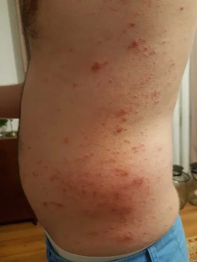 radomski_typ - Witam. Czy może ktoś wie co to jest? Lekarz dermatolog nie wie co to m...