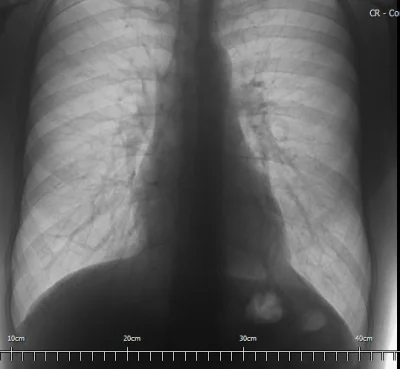 kosti9191 - #medycyna #radiologia #rtg #zdrowie

Mirki. To mój RTG płuc. Co to za d...