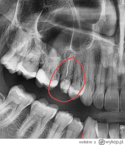 velldrin - Mam dylemat... Złamał mi się ząb w połowie, 5-tka górna, jest stan zapalny...
