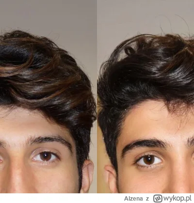 Alzena - Zrobili chłopakowi damski nos 🫤 i tak wygląda lepiej niż wcześniej ale….mog...