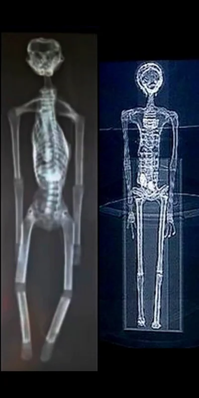 bialy100k - Zdjęcia rentgenowskie z 2017 (lewe) i z 2023 (prawe). Albo ja coś przeocz...