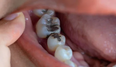 PiersiowkaPelnaZiol - Wszyscy mówią o lekarzach, ale nikt nie mówi o dentystach (też ...