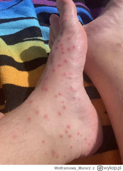 Wolframowy_Murarz - #pluskwy #alergia #wysypka #egipt #dermatologia 

Hej, jestem obe...